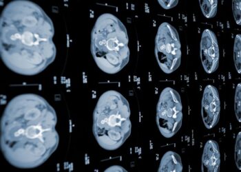 Inteligencia artificial china ayuda a detectar el cáncer de páncreas en una fase temprana