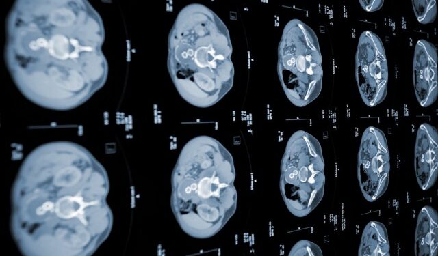 Inteligencia artificial china ayuda a detectar el cáncer de páncreas en una fase temprana