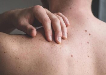 Estos son los lugares del cuerpo donde suelen aparecer lunares peligrosos