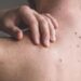 Estos son los lugares del cuerpo donde suelen aparecer lunares peligrosos