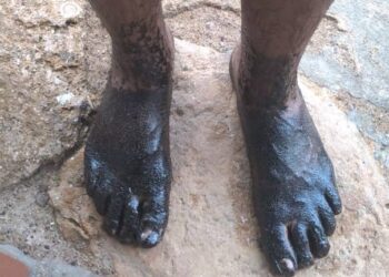 Otro derrame de crudo en playas de Paraguaná: Los turistas huyen al verse manchados por petróleo