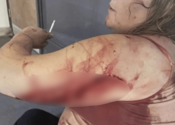 Descubrió que su novio le era infiel, lo enfrentó y él le partió una botella de vidrio en el cuerpo