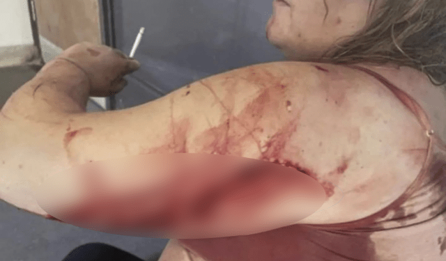 Descubrió que su novio le era infiel, lo enfrentó y él le partió una botella de vidrio en el cuerpo