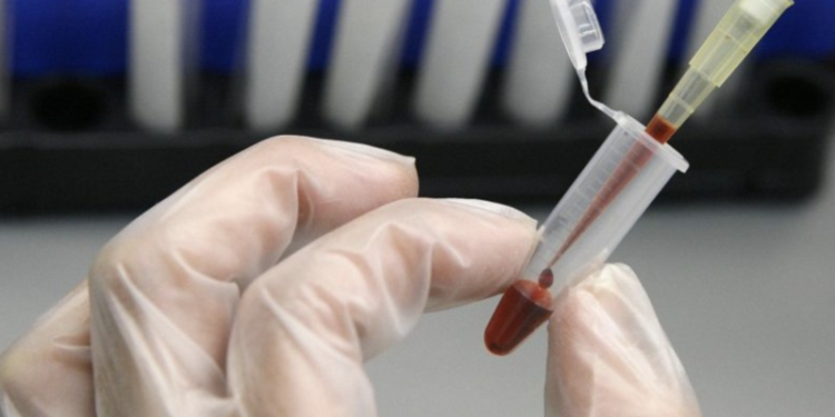 Gran preocupación por el aumento de casos de VIH entre la comunidad latina de EEUU.