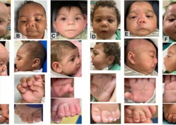 Crisis de fentanilo en EEUU: estudio destaca anomalías congénitas en recién nacidos