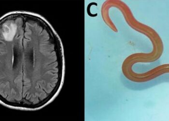 Un gusano vivo en el cerebro de una mujer y otras noticias de salud que causaron impacto en 2023