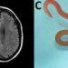 Un gusano vivo en el cerebro de una mujer y otras noticias de salud que causaron impacto en 2023