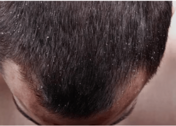 ¿Por qué se produce la caspa y cuáles son los tratamientos?