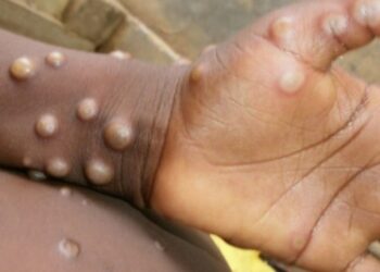 Japón registra su primer fallecimiento por viruela símica