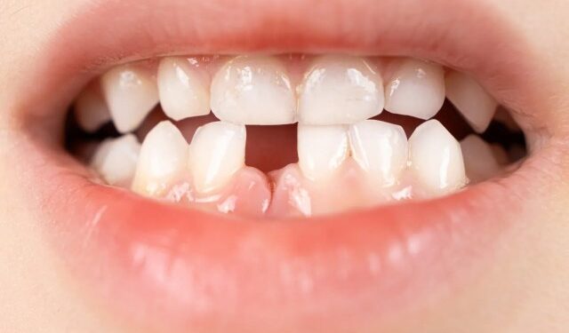 Finalmente revelaron qué significa soñar que se te caen los dientes