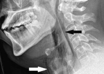 La advertencia médica después de que un hombre se perforara la garganta al evitar un estornudo