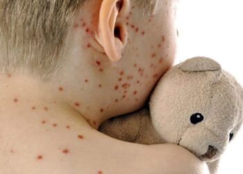 La OMS alerta de la subida “alarmante” de casos de sarampión en Europa