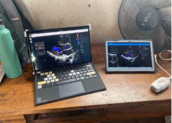 Cómo funciona la herramienta de IA que puede diagnosticar una enfermedad cardíaca oculta en los niños