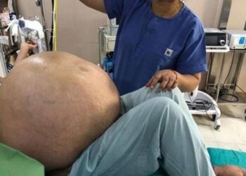 Extirpan un tumor de más de 50 kilos del abdomen de una mujer en Italia