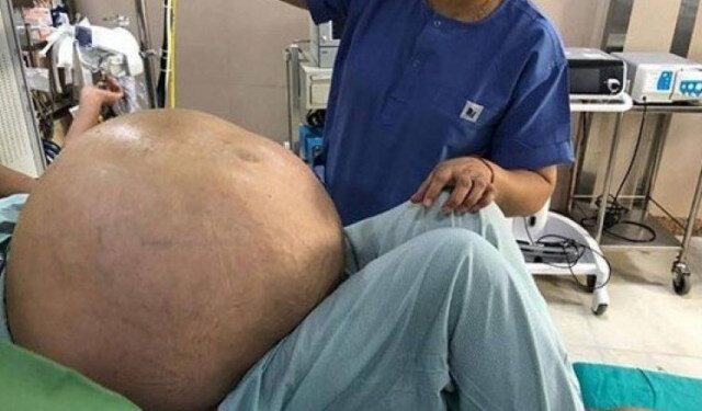 Extirpan un tumor de más de 50 kilos del abdomen de una mujer en Italia