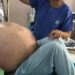 Extirpan un tumor de más de 50 kilos del abdomen de una mujer en Italia