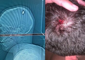 Pasó cuatro días de fiesta sin saber que tenía metida una bala en su cabeza