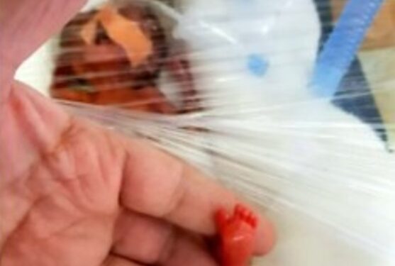 Salvaron a la “Bebé pluma”: pesaba 250 gramos al nacer y ya está en su casa