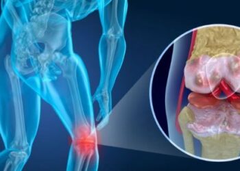 Todo lo que debes saber sobre la artrosis, la enfermedad degenerativa articular mas frecuente