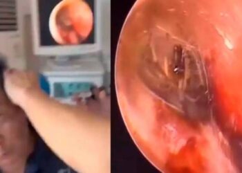 ¡Increíble! Descubren araña y su nido dentro del oído de un hombre (VIDEO)