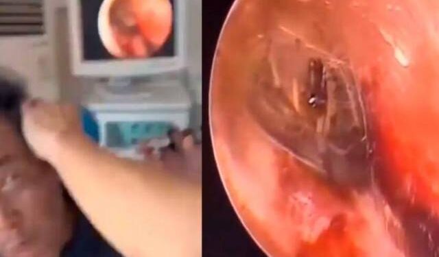 ¡Increíble! Descubren araña y su nido dentro del oído de un hombre (VIDEO)