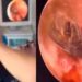 ¡Increíble! Descubren araña y su nido dentro del oído de un hombre (VIDEO)