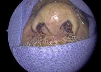 Le extraen 150 insectos vivos de la nariz a un hombre en Florida y ni siquiera sabía que estaban allí