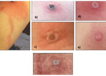 ¿De qué se trata el virus de Alaska que enciende las alertas en Estados Unidos?