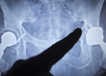 Piden crear banco de prótesis de cadera y rodillas para pacientes con bajos recursos económicos