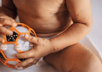 OMS insta a una respuesta urgente contra el sarampión para proteger a millones de niños en Europa