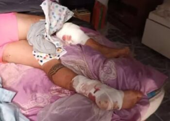 “Lo mordieron más de 50 veces”: dos pitbulls se metieron en una casa y atacaron a un joven