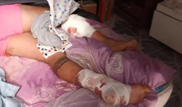 “Lo mordieron más de 50 veces”: dos pitbulls se metieron en una casa y atacaron a un joven