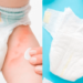 Bebés: ¿qué causa la dermatitis del pañal en ellos y cómo se puede tratar?