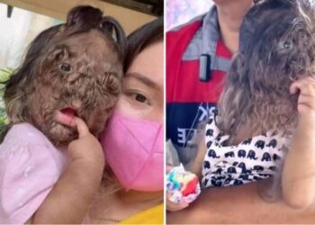 Adik Missclyen, la niña de dos años que se hizo viral por sufrir el “síndrome del hombre lobo”
