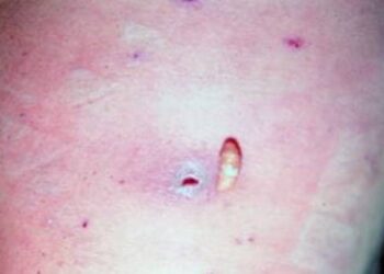 En Panamá detectan dos casos del gusano barrenador en humanos