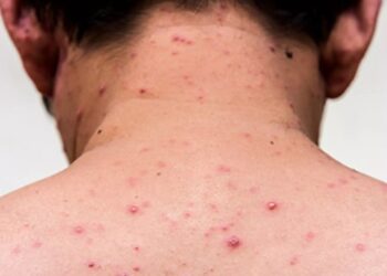 Casos de sarampión en EEUU aumentan a 41, mientras los CDC contabilizan infecciones ahora en 16 estados