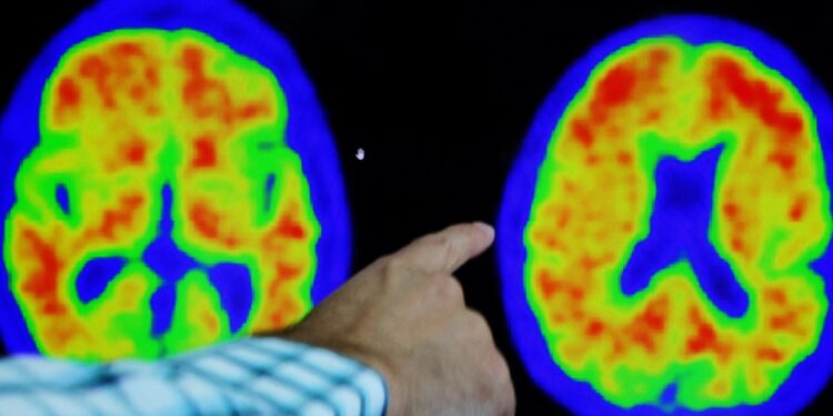 El fármaco contra el Alzheimer de Eisai y Biogen sufre un revés en Europa