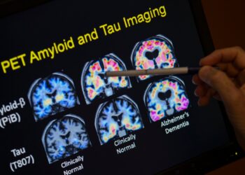 Los análisis de sangre para detectar el Alzheimer podrían estar a la vuelta de la esquina