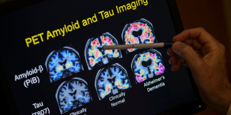 Los análisis de sangre para detectar el Alzheimer podrían estar a la vuelta de la esquina