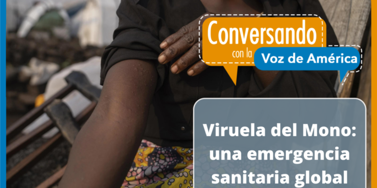 La viruela del mono, un virus que se propaga ante la preocupación de expertos