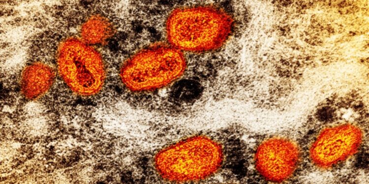 Suecia reporta primer caso de forma más infecciosa de viruela símica