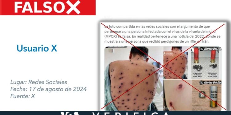 La persona de esta imagen no tiene lesiones por rifle como se dice en X, es un caso de viruela símica