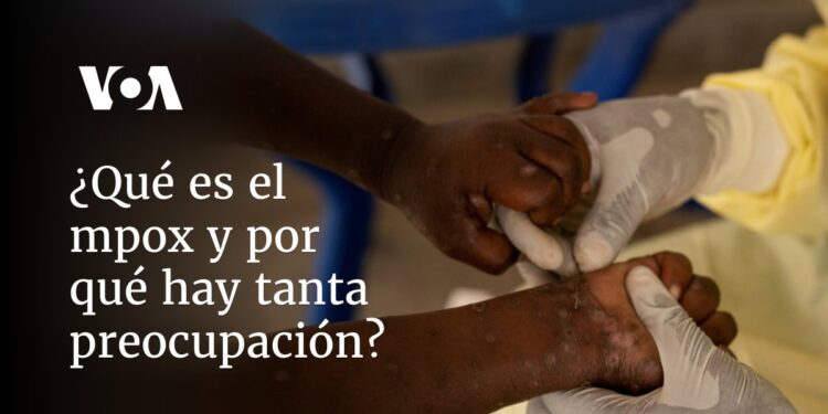 ¿Qué es el mpox y por qué hay tanta preocupación?