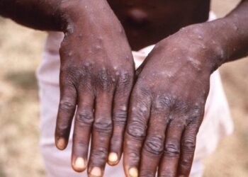 La viruela del mono es declarada una emergencia de salud pública mundial