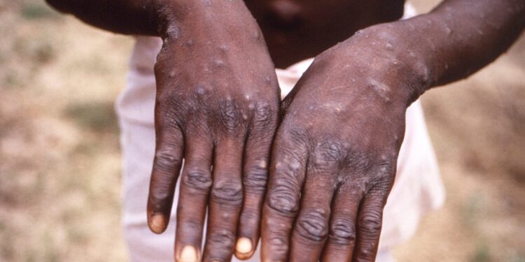 Mpox no es el nuevo COVID, aclara funcionario de la OMS