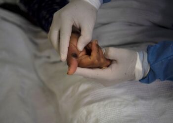 Venezuela anuncia plan de vigilancia epidemiológica debido a la viruela del mono