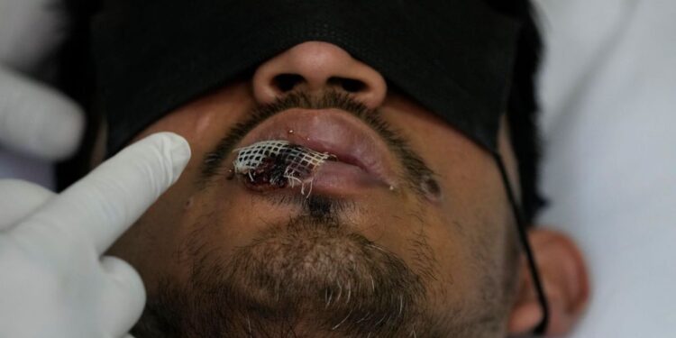 OMS declara emergencia de salud pública por viruela símica, su máximo nivel de alerta