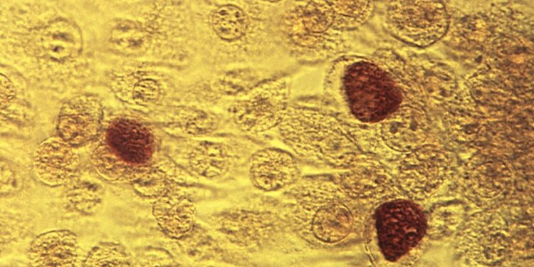 Enfermedades de transmisión sexual en EEUU empiezan a disminuir tras fuerte repunte de años pasados