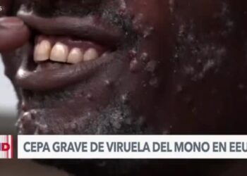 La cepa más grave de viruela del mono llega a Estados Unidos, según los CDC