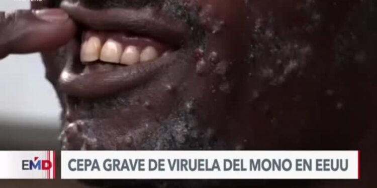 La cepa más grave de viruela del mono llega a Estados Unidos, según los CDC